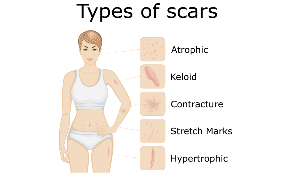 types of scars
