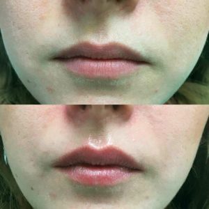 liplase before and after