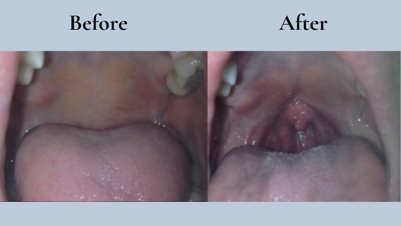 Nightlase laser snoring treatment before after 2