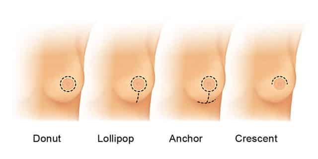 Breast Lift Incision Techniques
