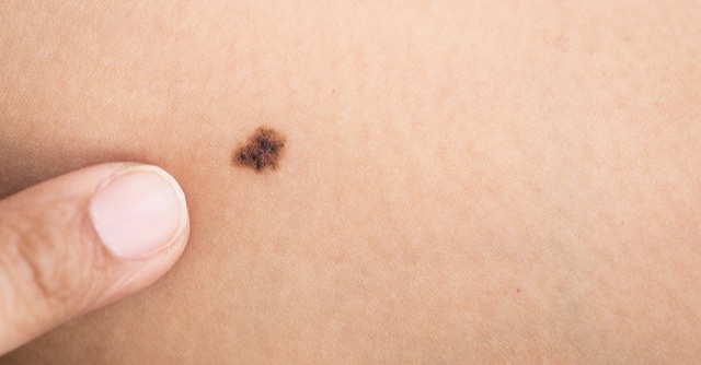 mole removal surgery london uk