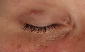 laser skin tag removal before