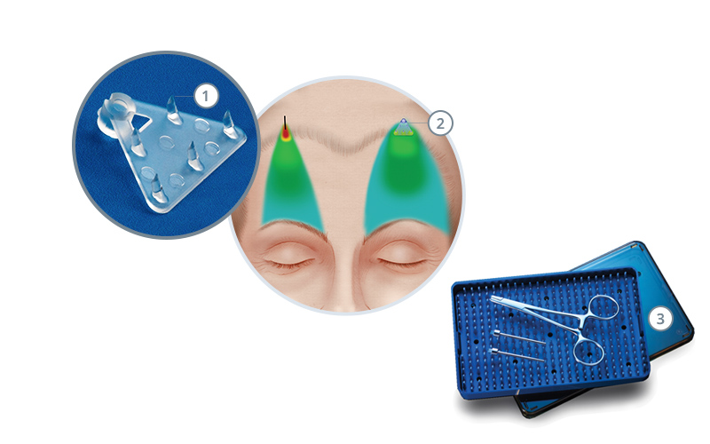 endoscopic brow lift endotine