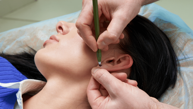 Pixie Ear Correction After Botched Facelift