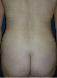 flank lipo after
