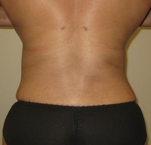 flank liposuction after