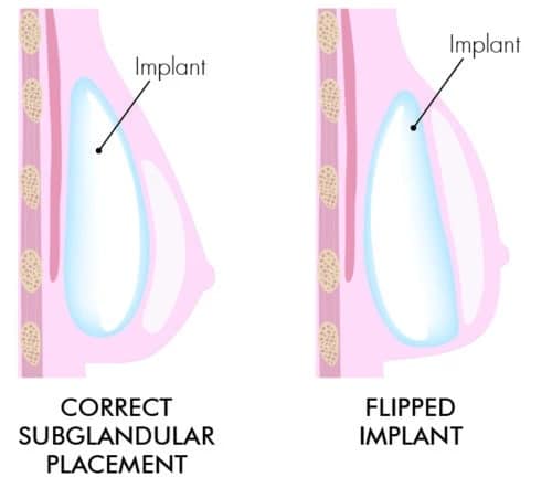 Breast Implant Flipping