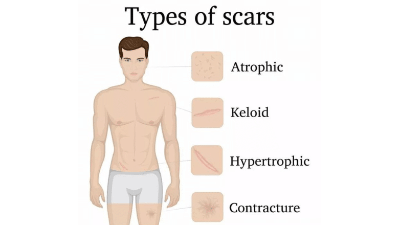 types of scars